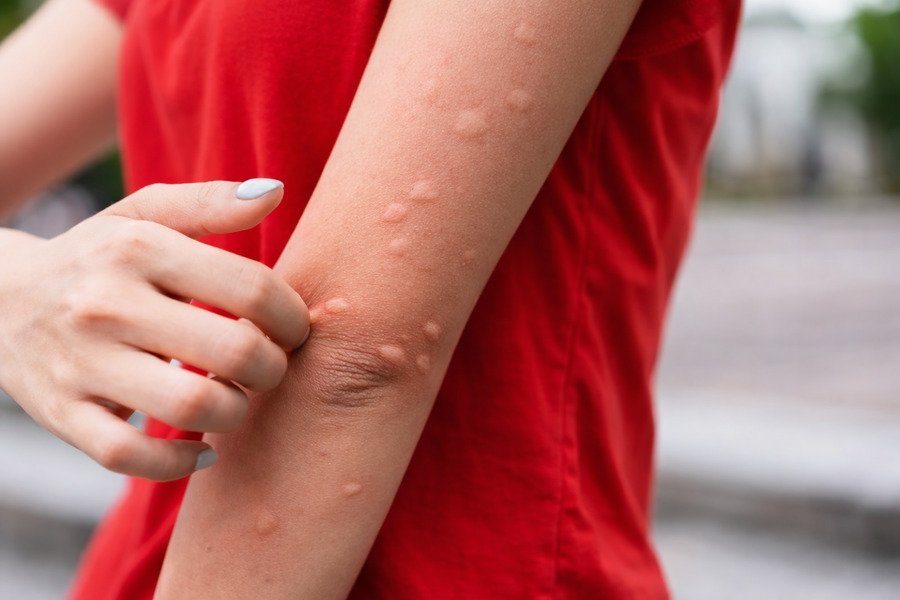 What termite treatment options are safe for pets and children - Person scratching irritated skin on arm.